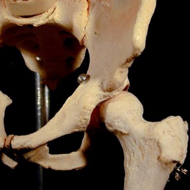 Opcao para capa Vida especial sobre cirurgia de quadril quadril,cirurgia,esqueleto