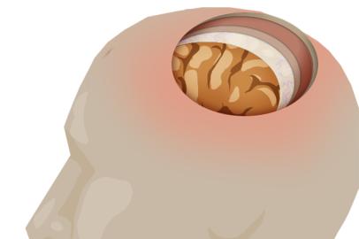 zh gráfico meningite