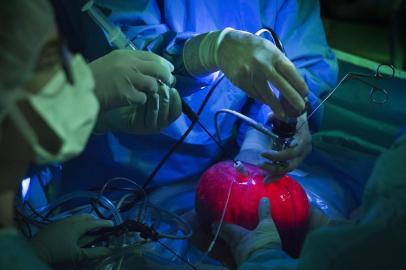 SURGERY-GRADY-NSPR-103117

Surgeons use an experimental technique in which the uterus is lifted from a womanâs body to operate upon a fetus with spina bifida, at the Texas Childrenâs Hospital in Houston, Sept. 26, 2017. Performed since the 1990s, fetal surgeries to repair spina bifida can lessen the degree of disability. This new technique has split opinions in the medical community. (Beatrice de Gea/The New York Times)

Editoria: A
Local: HOUSTON
Indexador: BEATRICE DE GEA
Fonte: NYTNS
Fotógrafo: STR