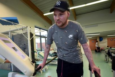 Franck, 33-year-old who had suffered burns over 95 percent of his body and was saved by a skin transplant from his identical twin Eric, in a world-first operation, attends a physiotherapy session at the rehabilitation centre in Corbie, near Amiens, on November 23, 2017.  / AFP PHOTO / FRANCOIS LO PRESTI