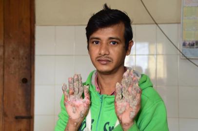  This picture taken on January 25, 2018 shows Tree Man Abul Bajandar showing his palms where the warts are regrowing at Dhaka Medical College Hospital in Dhaka.Bark-like warts have returned to the hands and feet of a Bangladeshi father, dubbed the Tree man, after two dozen surgeries have apparently failed to cure him. Doctors in Bangladeshs capital Dhaka last year were on the verge of declaring they had successfully treated Abul Bajandar, 27, whose hands and feet were covered with foot-length barks for the last decade. / AFP PHOTO / Sam JAHANEditoria: HTHLocal: DhakaIndexador: SAM JAHANSecao: healthcare policyFonte: AFPFotógrafo: STR