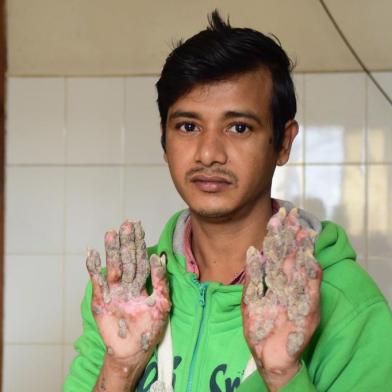  This picture taken on January 25, 2018 shows Tree Man Abul Bajandar showing his palms where the warts are regrowing at Dhaka Medical College Hospital in Dhaka.Bark-like warts have returned to the hands and feet of a Bangladeshi father, dubbed the Tree man, after two dozen surgeries have apparently failed to cure him. Doctors in Bangladeshs capital Dhaka last year were on the verge of declaring they had successfully treated Abul Bajandar, 27, whose hands and feet were covered with foot-length barks for the last decade. / AFP PHOTO / Sam JAHANEditoria: HTHLocal: DhakaIndexador: SAM JAHANSecao: healthcare policyFonte: AFPFotógrafo: STR