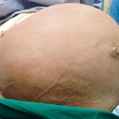  Tumor uterino gigante