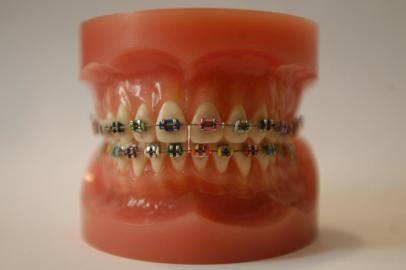 Aparelho Ortodôntico,fotos de Dentaduras(moldes)com braquetes metálico e de cerâmica colados nos dentes(dentaduras do dentista Carlos)