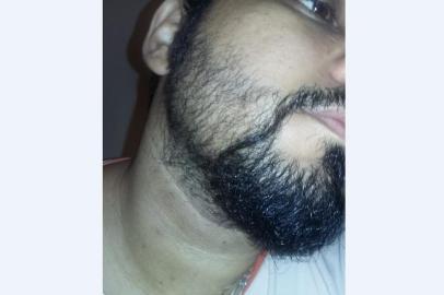 Uma cirurgia delicada e de curto tempo para recuperação. Já pensou em mover fios de cabelo para o rosto e adquirir uma barba comum, um cavanhaque, uma costeleta ou um bigode? O transplante de barba, ainda pouco conhecido, passa por um boom: entre 2014 e 2016, aumentou em 101% no mundo, segundo dados da Sociedade Internacional de Cirurgia de Restauração Capilar (SHRS, na sigla em inglês). No Brasil, profissionais da área também notam aumento de procura pelo procedimento ¿ levantamento do Instituto de Medicina do Cabelo, clínica especializada de Fortaleza (CE), mostra incremento de 40% no procedimento que pode ser estético ou aplicado para cobrir cicatrizes. 