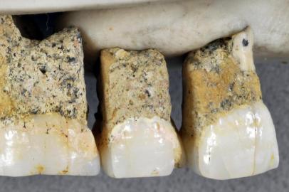 A row of upper teeth of Homo luzonensis, including, from left to right, two premolars and three molars.An image provided by the Callao Cave Archaeology Project shows a row of upper teeth of Homo luzonensis, including, from left to right, two premolars and three molars. Archaeologists in the Philippines discovered fossilized remains of a new species of hominin, further expanding the human family tree. (Callao Cave Archaeology Project via The New York Times) -- NO SALES; FOR EDITORIAL USE ONLY WITH NYT STORY SCI-HUMAN-SPECIES-DISCOVERY BY CARL ZIMMER FOR APRIL 15, 2019. ALL OTHER USE PROHIBITED. --Editoria: ALocal: UNDATEDIndexador: CALLAO CAVE ARCHAEOLOGY PROJECTSecao: IFonte: CALLAO CAVE ARCHAEOLOGY PROJECTFotógrafo: HO