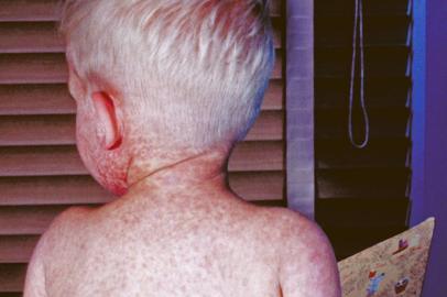 In a photo from the Centers for Disease Control and Prevention, a boy with measles in 1963.**EMBARGO: No electronic distribution, Web posting or street sales before 2:31 a.m. ET Tuesday, June 18, 2019. No exceptions for any reasons. EMBARGO set by source.** In a photo from the Centers for Disease Control and Prevention, a boy with measles in 1963. Data from a federal program designed to compensate people harmed by vaccines shows how rare it is for someone to claim they were hurt after getting vaccinated. (Centers for Disease Control and Prevention via The New York Times) -- FOR EDITORIAL USE ONLYEditoria: ALocal: UNDATEDIndexador: CENTERS FOR DISEASE CONTROL AND PREVENTIFonte: CENTERS FOR DISEASE CONTROL AND PREVENTIFotógrafo: HO