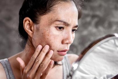  PORTO ALEGRE, RS, BRASIL, 07/10/2019- sad Asian woman having skin problem checking her face with dark spot, freckle from uv light in mirror. ( Foto: doucefleur / Fonte: 287549957<!-- NICAID(14280117) -->