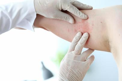 Male doctor in white protective gloves examing patientMale doctor in white latex gloves examines patient with skin disease against office background. Allergy treatment conceptFonte: 299235713<!-- NICAID(14505000) -->