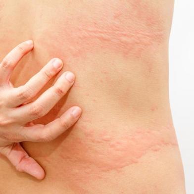  Women with symptoms of itchy urticaria.Fonte: 119502415Fotógrafo: Women with symptoms of itchy urt<!-- NICAID(14516283) -->